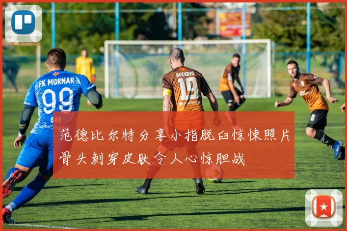 范德比尔特分享小指脱臼惊悚照片骨头刺穿皮肤令人心惊胆战